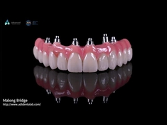 Híbrido Implante de porcelana rosa Corona Malong Puente de implante de arco completo Carga inmediata