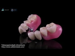 Telescopio Co-Cr interior y Co-Cr exterior de metal parcial con compuestos