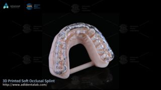 Férula impresa en 3D personalizada para aliviar el bruxismo