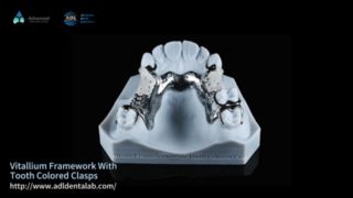 Vitallium Framework Estética Natural Fácil Ajuste