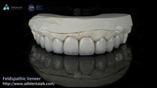 Carillas de cerámica feldespática de alta translucidez para sonrisas