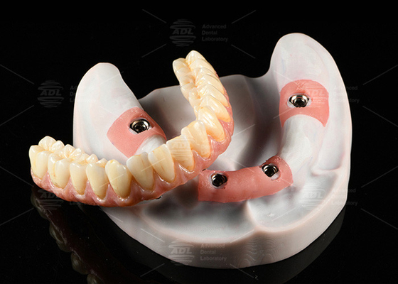 comprar Coroneta de porcelana rosa compuesta A1 sombra todo en 4 tornillo de titanio híbrido retenido Fabricación en línea