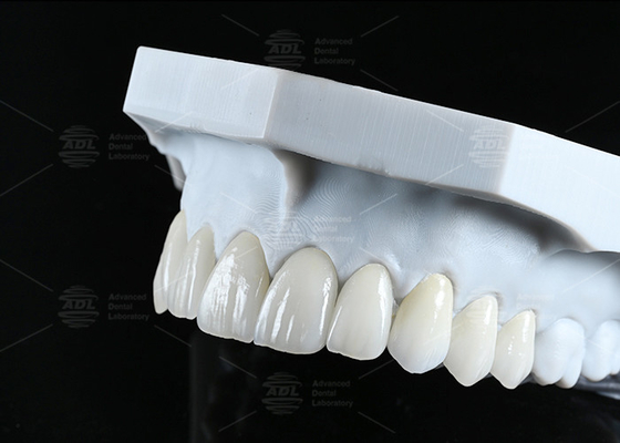 comprar Translucidez CAD EMAX Veneer Pulida Restauración de cerámica acristalada para áreas anteriores y posteriores Fabricación en línea