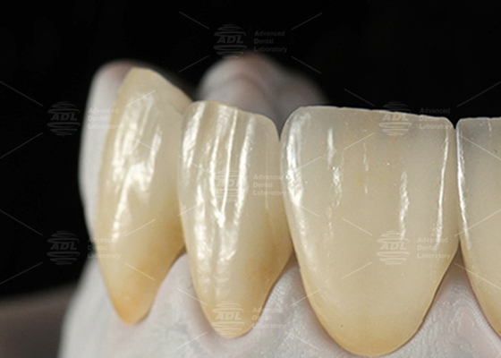 comprar 0.3mm-0.7mm Carillas de cerámica EMAX Feldspathic Carillas dentales Emax estéticas naturales Fabricación en línea