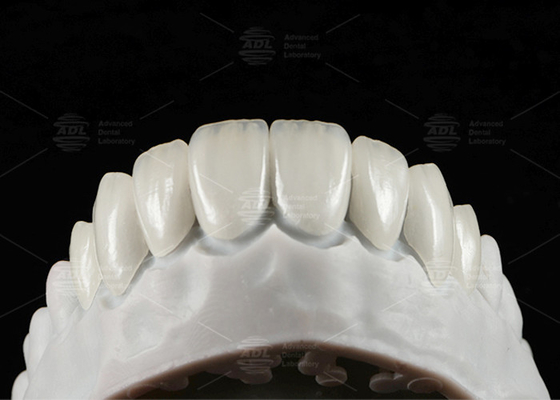comprar Carillas dentarias de EMAX prensadas naturales 16 tonos Fabricación en línea