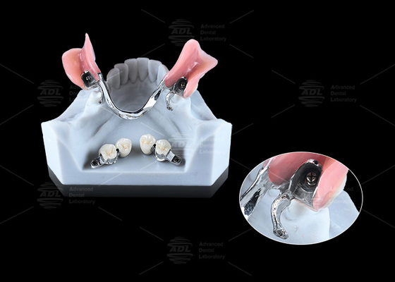 comprar 0.1 mm Tolerancia CEKA REVAX Acoplamiento Titanio 3 mm Libertad vertical Fabricación en línea