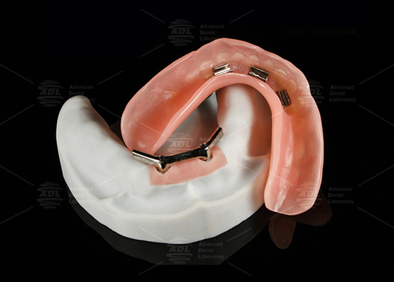 comprar Enlace de titanio con una barra de implantes de DOLDER Dentadura sobredentada pulida para una sonrisa natural Fabricación en línea