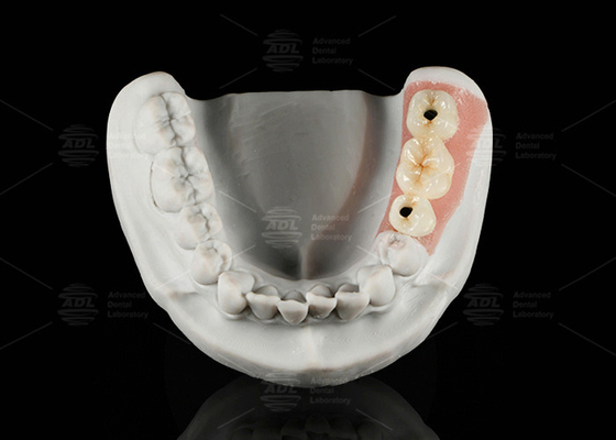 comprar Porcelana de titanio con retención de tornillo de abutment personalizado fundido con zirconio Fabricación en línea