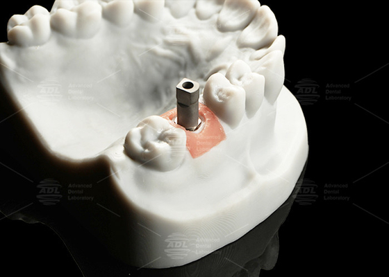 comprar Implante digital de titanio de precisión para escanear el cuerpo Fabricación en línea