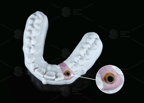 comprar El hexágono interno de titanio personalizado abutment tornillo de cemento mantenido forma variable Fabricación en línea