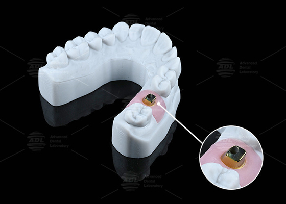 comprar Implantes dentales y soluciones de titanio personalizados resistentes a la corrosión Fabricación en línea
