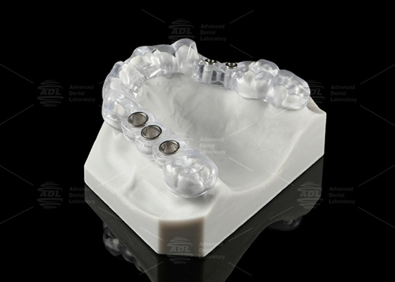 comprar Solución de implantes dentales transparentes hechos a medida Diseño ergonómico del stent quirúrgico Fabricación en línea