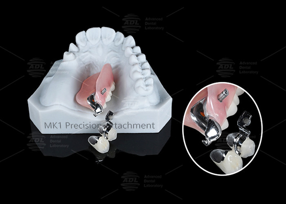 comprar MK1 Accesorio de precisión Dentadura parcial extraíble Fácil de instalar Fabricación en línea
