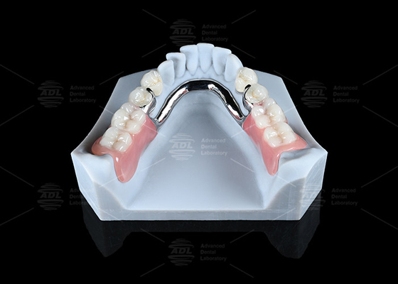 comprar Accesorios de precisión ERA multifuncionales ajustables Accesorios ERA extraíbles para dentaduras Fabricación en línea