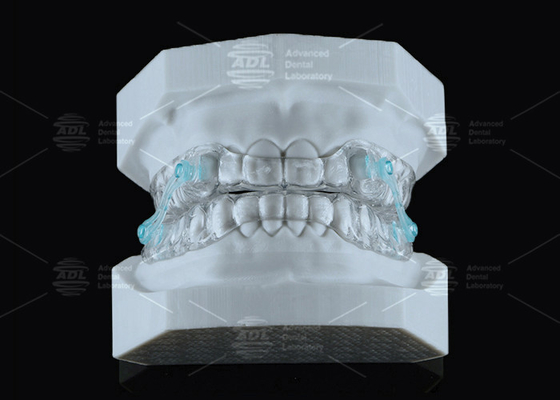 comprar Silenciador Erkodent Transparente Anti ronquido Boquilla de ajuste personalizado Reducción de ruido Fabricación en línea