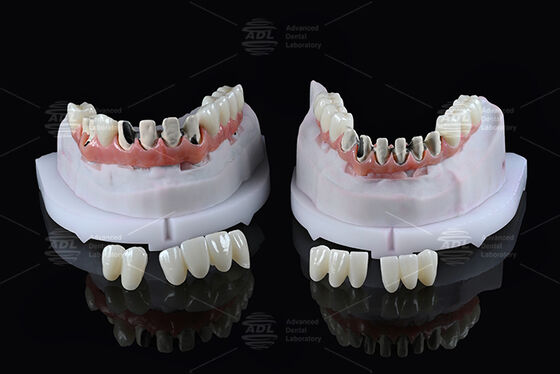 comprar Puente Híbrido de Arco Completo de Titanio para Laboratorio Dental de China con Carga Inmediata Tono A1 Diseño Malong Atornillado Cad/Cam Fabricación en línea