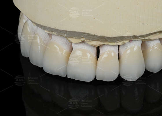 Color natural de los dientes Cerámica de carilla feldspática para dientes anteriores y posteriores