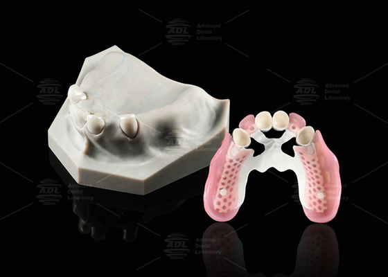 Biocompatibilidad Telescopio Dental Blanco Circónia Interior Telescopio Dental
