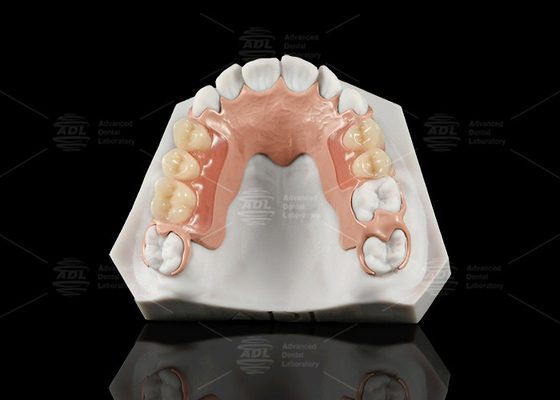 Dentadura parcial flexible de acrílico con excelente resistencia