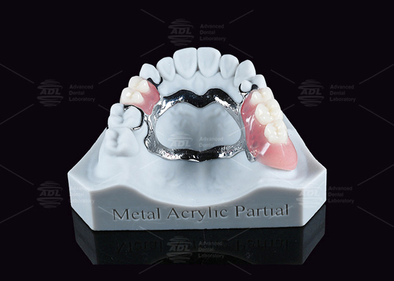 Dentadura parcial acrílica metálica extraíble con pinzas para masticar parcialmente