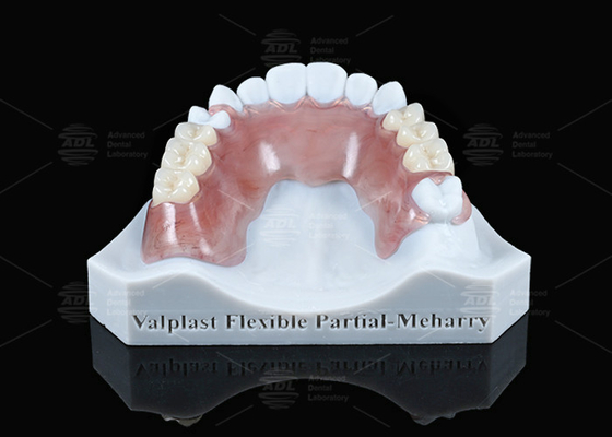Valplast ligero parcial flexible con excelente retención en rosa y maíz