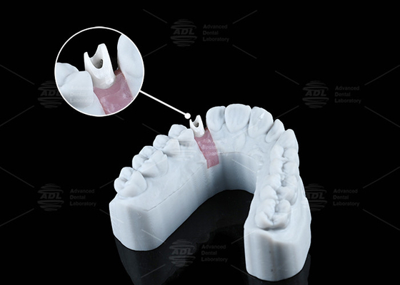 Abutment de zircónía blanco personalizado de aspecto natural Estética y funcionalidad óptima