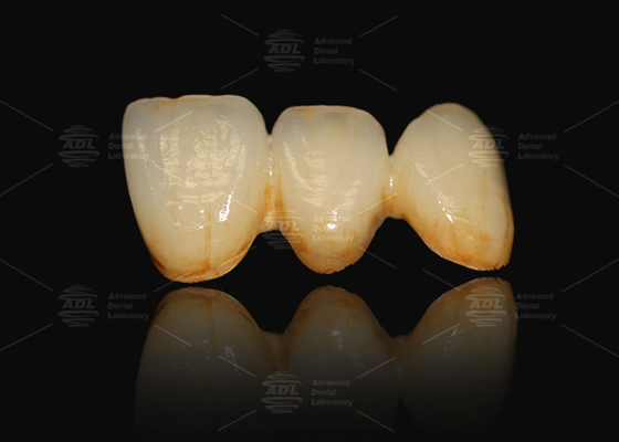 A3 A3.5 Porcelana fundida con metal y corona dental cerámica PFM Cad Cam