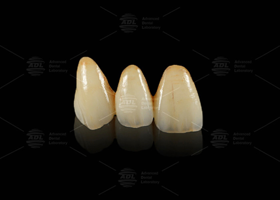 Puente dental Emax Hipoalergénico y duradero