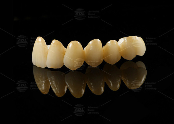 Porcelana estética fuerte fusionada con zirconio para restauraciones de aspecto natural