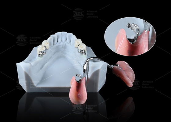 Aplicaciones dentales ERA de precisión elegante para prótesis dentales seguras universales