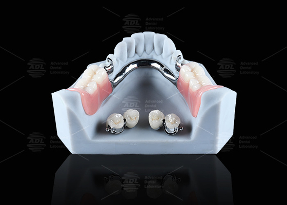 Implantes dentales de titanio con conexiones de bolas confortable retención de dentadura segura