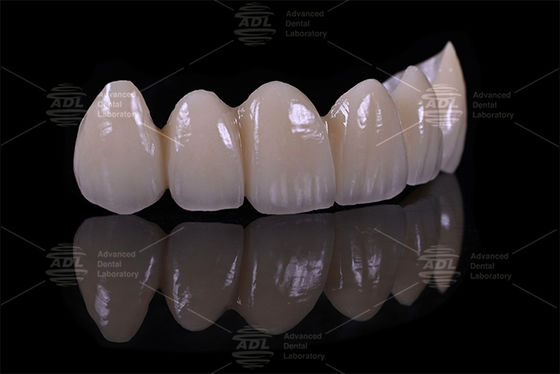Top 5 China dental lab providers Porcelain Fused To Zirconia ensuring turnaround time in 72 hours service for dental offices and labs