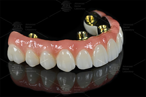 Servicios de externalización de laboratorios dentales profesionales que ofrecen prótesis dentales precisas y soluciones personalizadas para las necesidades de la industria dental