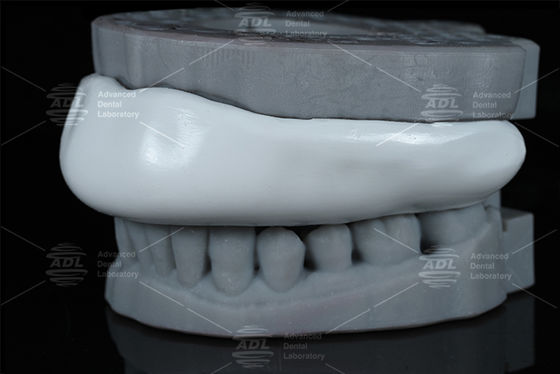 Conveniente Occlusal Splint Sport Guard Bite Splint Diseño fácil de limpiar Dispositivo de protección cómodo para el rechinar dientes