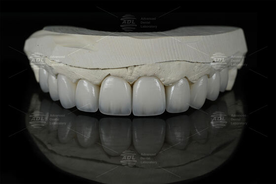 0.3mm-0.7mm Carillas de cerámica EMAX Feldspathic Carillas dentales Emax estéticas naturales